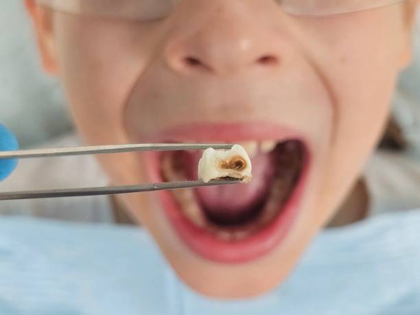 Best Emergency Dentist for Knocked-Out Tooth in Sandy, OR